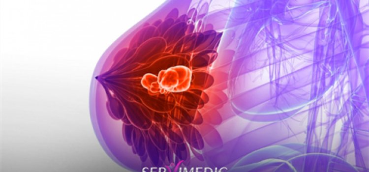 Dicas Para a Prevenção do Câncer de Mama